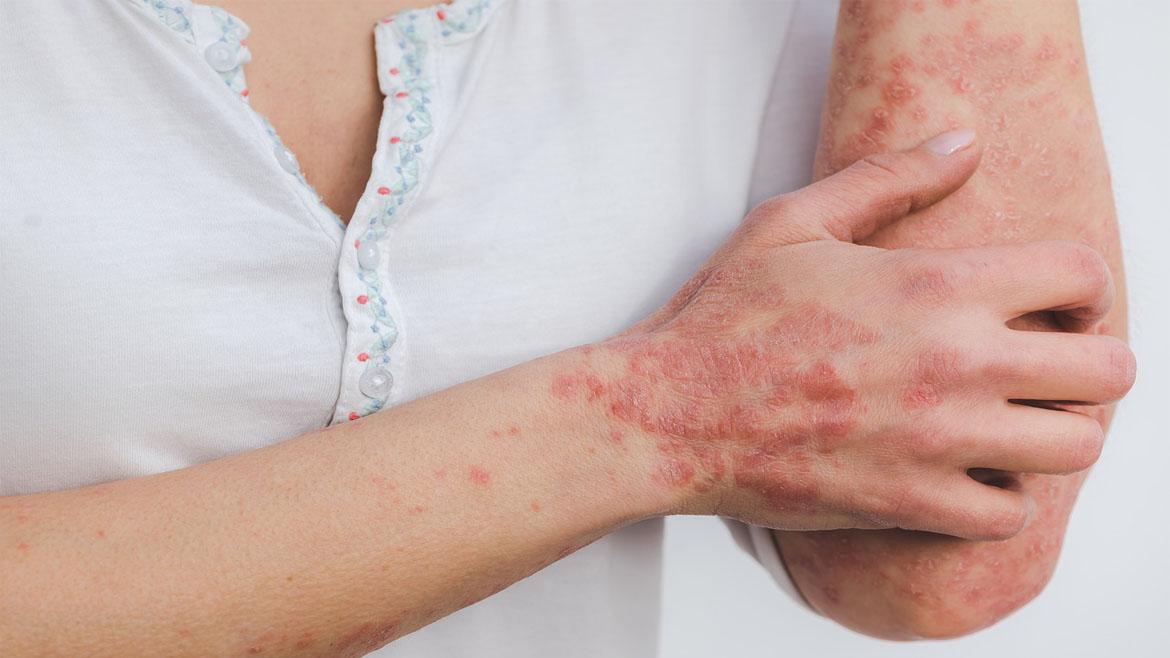 El Hospital del Sureste incorpora la experiencia del paciente en Dermatología
