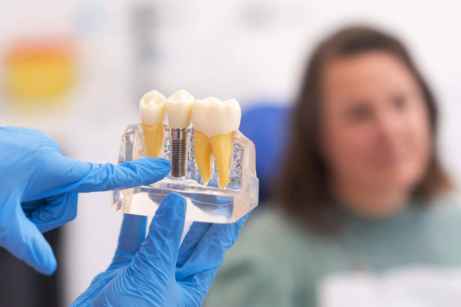 Los implantes dentales se consolidan como la opción preferida para recuperar dientes perdidos