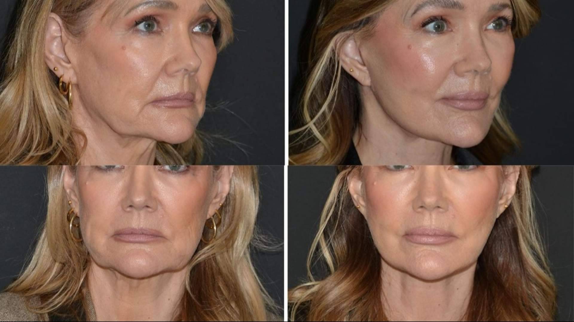 Deep Plane Facelift; la técnica que marca la nueva era del rejuvenecimiento facial este 2026
